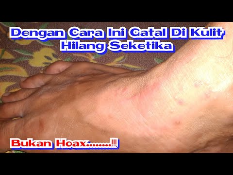 Cara Unik Mengatasi Gatal Di Kulit #Mengobati Gatal Dikulit