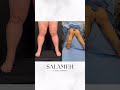 LippyLipo Treatment for Lipedema #lipedemaawareness #lipedema