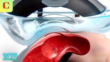 Destroying Tumors with SOUND: Histotripsy Demo & Explainer