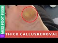 Thick Callus Removal | Miss Foot Fixer | Marion Yau