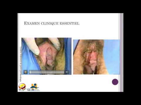 Vidéo: Chirurgie De L'incontinence Urinaire: Avantages Et Inconvénients, Indications