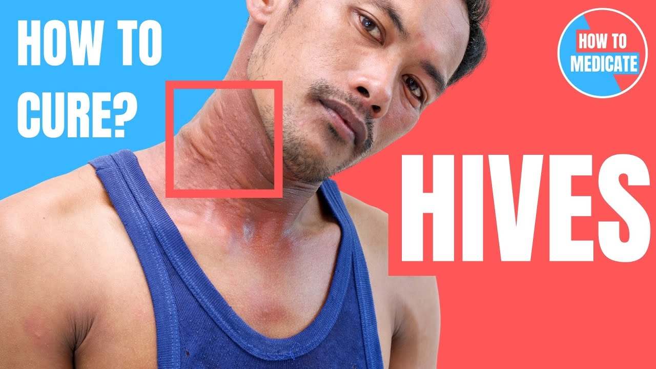How to treat Hives (Urticaria)? - Doctor Explains - YouTube
