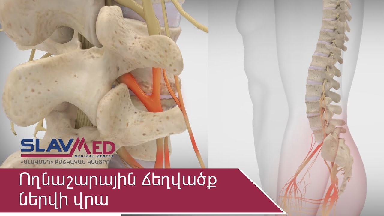 Ողնաշարային ճողվածք ներվի վրա