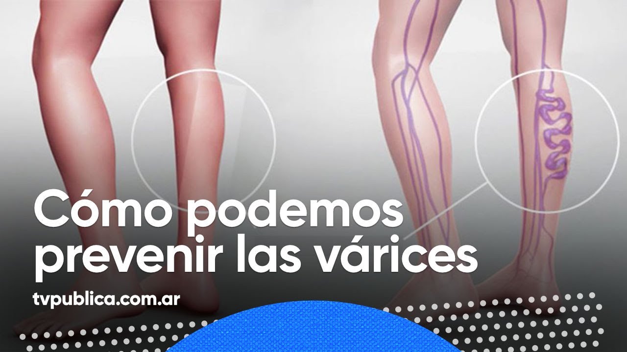 Varices: síntomas, tratamientos, causas e información.