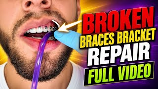 I Broke a Bracket on My Braces – Watch the Full Repair