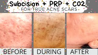 Subcision + PRP + Co2 Laser for True Acne Scars