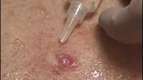 Injection of Local Anesthetic