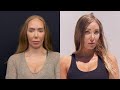 Woman Unhappy With Forehead Size Gets Reduction Surgery