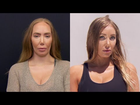 Video: Există operația pe frunte?