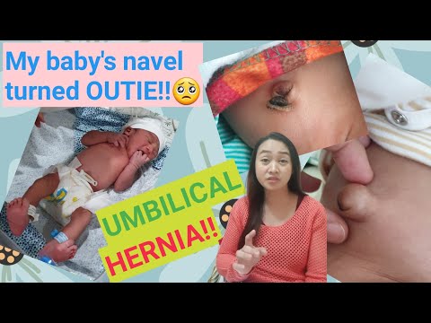 Video: Paano Gamutin Ang Isang Umbilical Hernia Sa Mga Bata