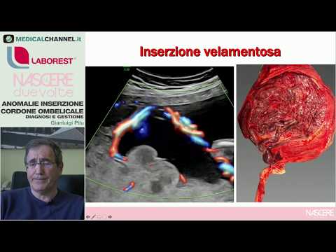 Video: Entanglement Del Cordone Ombelicale: Cause E Conseguenze