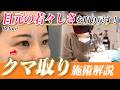 【33歳 目の下のクマ取り】裏ハムラだけじゃない❗️✨脱脂適応症例👁️【脱脂+ヒアルロン酸】