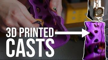 Custom Casts with 3D Printing | St. Luke