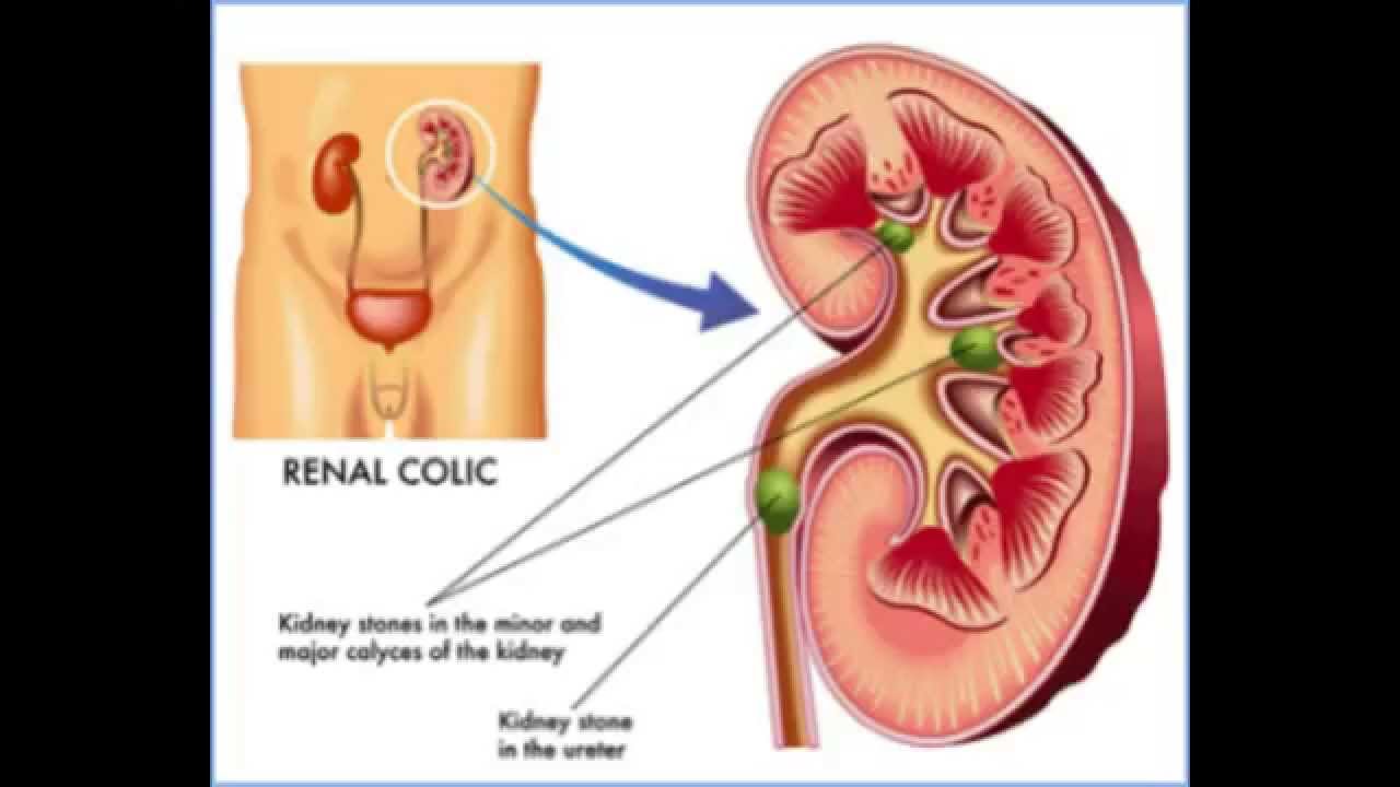 How To Get Rid Of Kidney Stones - Kidney Stone Relief - How To Dissolve Kidney Stones - YouTube