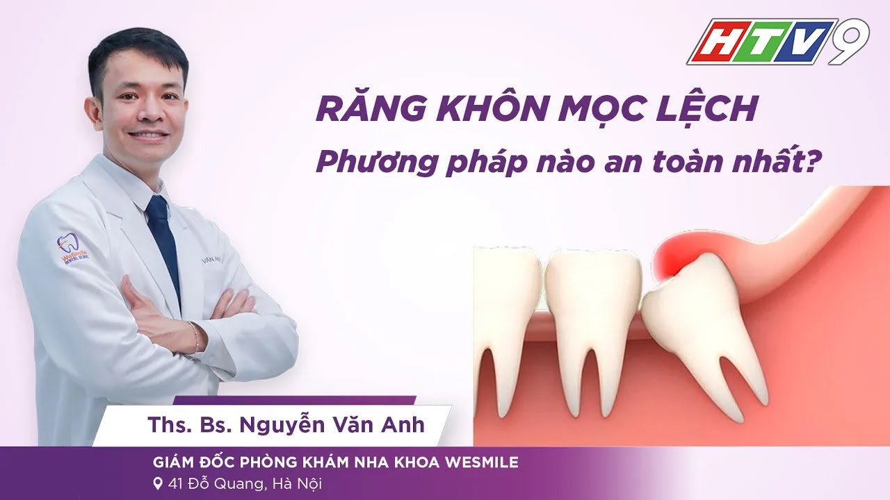 Răng Khôn Mọc Lệch Mọc Ngầm (Tiêu Điểm Y Tế - HTV9) Thạc sĩ Bác sĩ ...