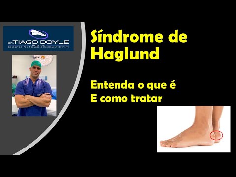 Vídeo: Deformidade De Haglund: Causas, Sintomas E Diagnóstico