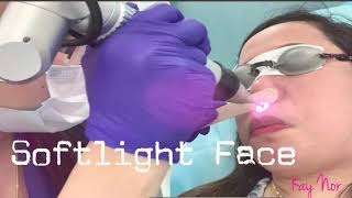 Softlight Laser Facial Hair Removal