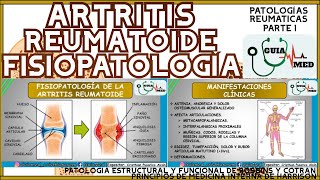 ARTRITIS REUMATOIDE FISIOPATOLOGÍA | GuiaMed