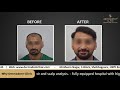 Hairtransplant naturalhairs besthairtransplantresults by dermadent clinic udaipur