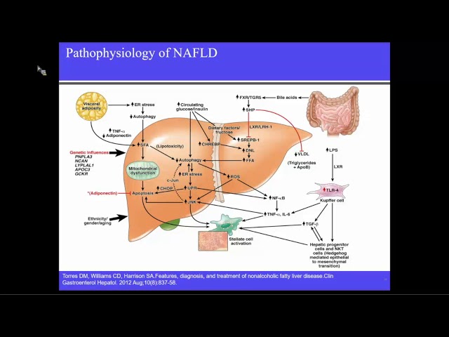 NAFLD/NASH Present & Future Management Options