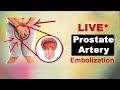 Prostate artery embolization i live i  pae i citi vascular center