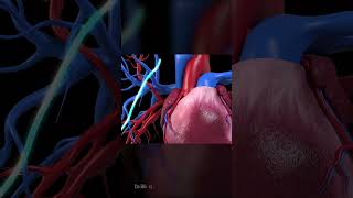 Single Heart Bypass Surgery: 3D Animation