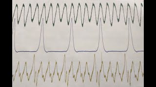 Intake and Exhaust Pressure Waveform Testing for Misfire