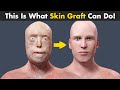 How Skin Transplant (Skin Graft) Is Performed? | Skin Graft Procedure