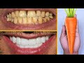 Teeth Whitening At Home In 2 Minutes / How To Naturally Whiten your Yellow Teeth And Tartar Removal