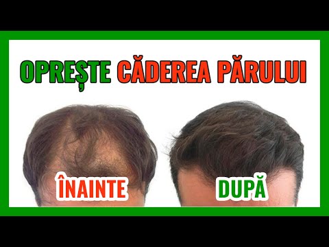 CADEREA PARULUI - TRATAMENT SI REMEDII IMPOTRIVA CADERII PARULUI