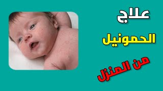 علاج الحمونيل بالاعشاب الطبيعيه في المنزل