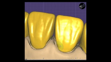 Monolithic crowns with texture #exocad #digitaldentisty #smiledesign #dentist #dentaltechnician