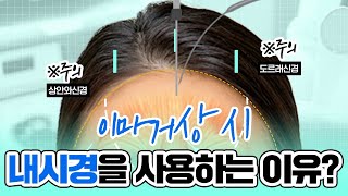 이마거상 시 내시경 사용은 선택이 아닌 필수! #내시경이마거상