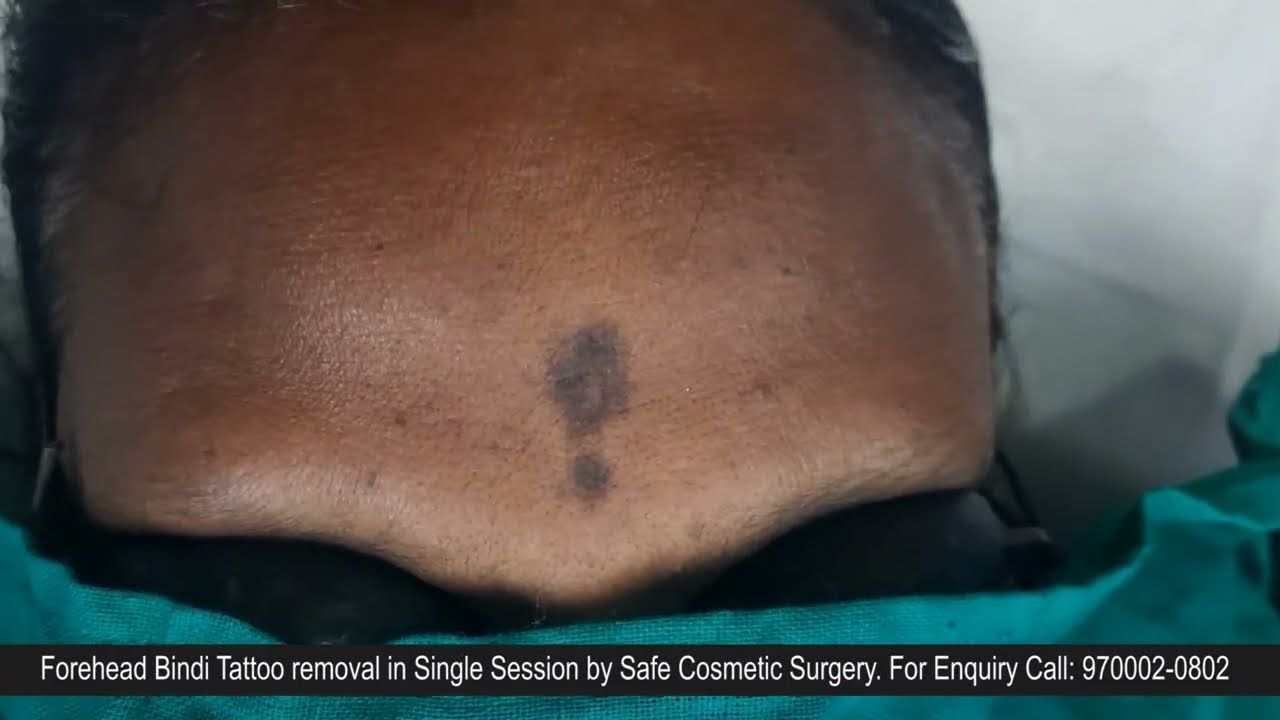 Bindi Tattoo Removal in Single Session by Mini Punch Excision Method.  Contact: 9700020802 - YouTube