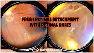 Fresh Retinal Detachment - Retinal Holes, Posterior Staphyloma, Nystagmus On Indirect Ophthalmoscopy