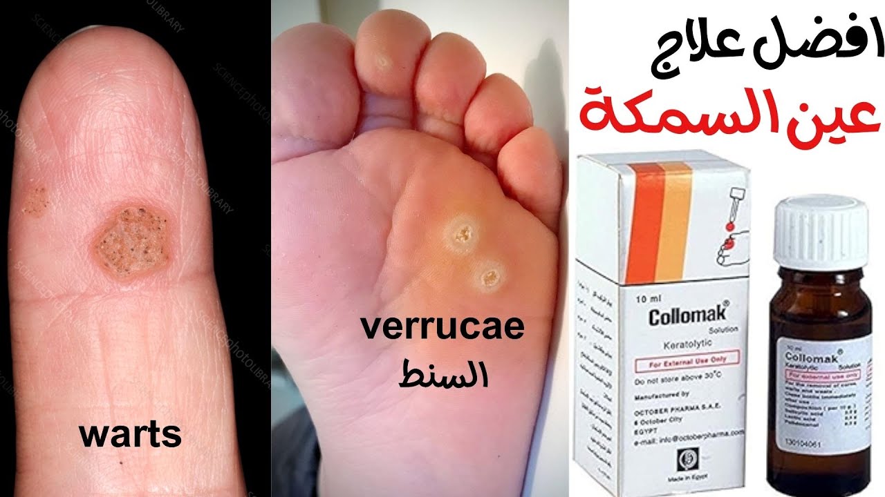 #عين السمكة  افضل علاج لعين السمكة #كولوماك #collomak #السنط #verrucae #warts