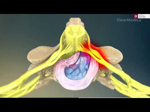 Hernia De Disc Cervicala Dr Dan Martin