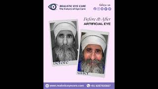 Looking for artificial eye services in Delhi?  #gayatrigaur #artificialeyecenterdelhi