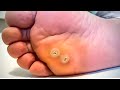 How To Remove a Foot Corn or Callus [Foot Doctor Home Treatment 2021]