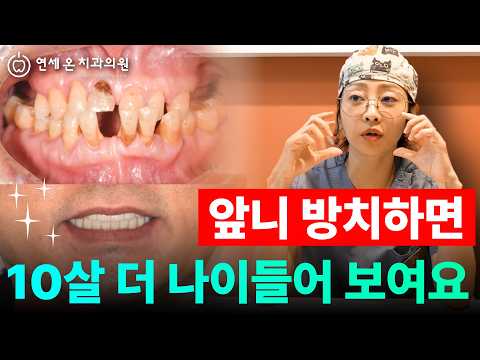 방치한 앞니, 10살 더 나이들어 보이는 이유 | 부산치과 연세온치과의원 — 연세온치과 유튜브 영상 썸네일