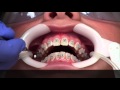 Getting Braces - How?