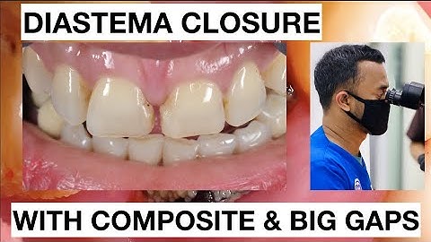 Step by Step Diastema Closure Composite with Big Gaps | General Dentist Griya RR