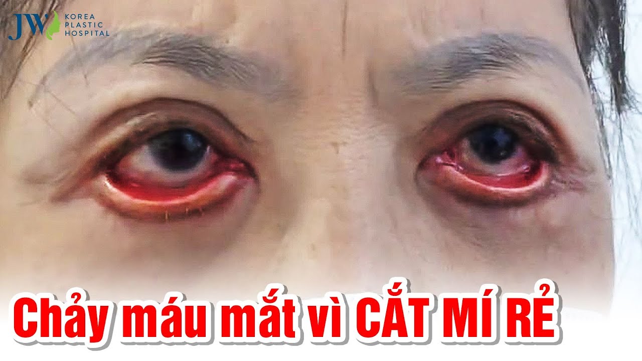 tham my vien ngoc yen ca mau Update CLIP NÓNG: THÓT TIM mắt TUÔN TRÀO MÁU ĐỎ vì CẮT MÍ MẮT giá rẻ tại Spa, Bác sĩ Tú Dung GIẬN SÔI MÁU