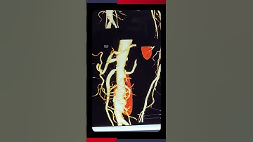 Advanced Endovascular Treatments | Indovasc Hospital | Minimally Invasive Vascular Care