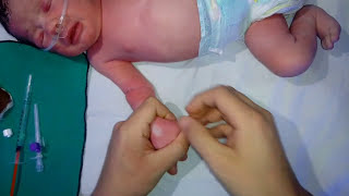 تركيب كانيولا للاطفال  IV cannula insertion for baby