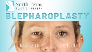 Eye Lid Lift | Everything You Need to Know About Blepharoplasty