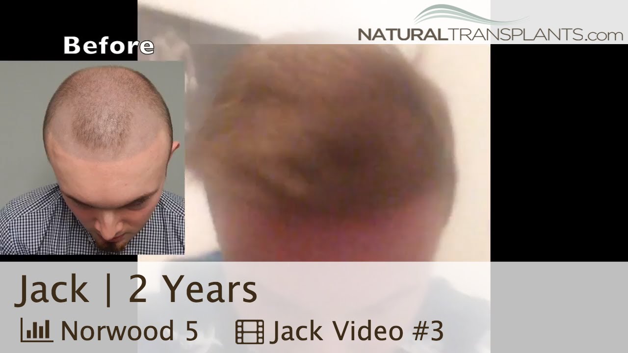 fue hair transplant month by month Hair Transplant Results | Best Hair Transplant Results (Jack)
