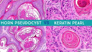 Keratin Pearl (SCC) vs Horn Pseudocyst (SK) (aka 