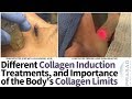 Collagen Induction - Treatments that Work, Products that Don't, and Limits of Treatment