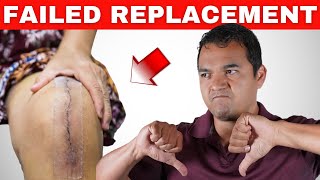 4 Key Signs of a Failed Knee Replacement You Shouldn't Ignore